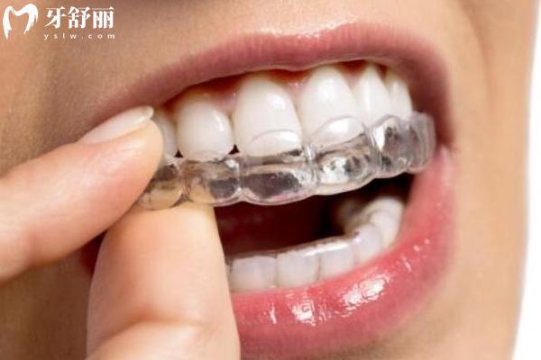 数字化隐形正畸是什么意思？原理+优势+局限性等详细了解