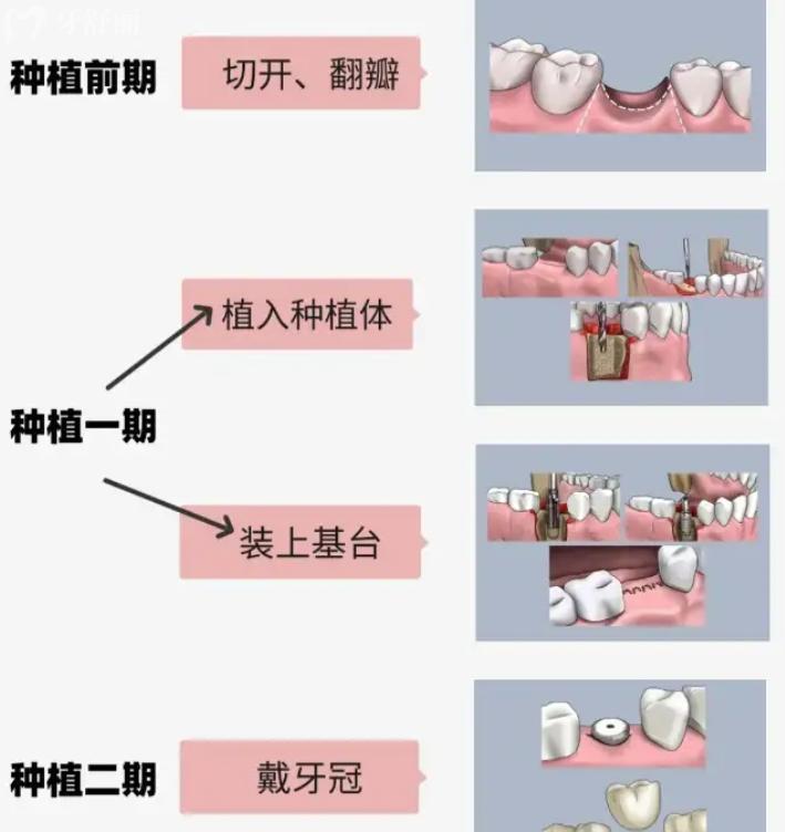 种植牙过程