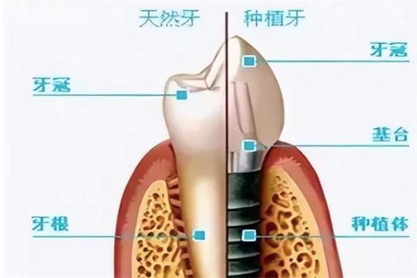种牙需要几次才能种好?种牙要几次才能完成跟牙槽骨条件有较大关系