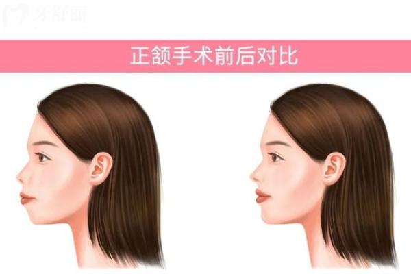 章建林正颌手术怎么样