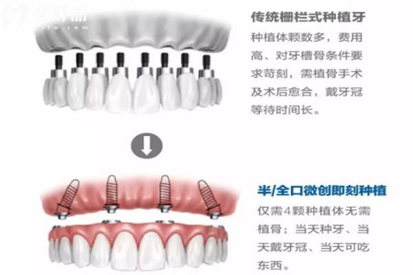 满口种植牙大概多少钱?查询老人全口假牙价目表可知3-20w不等可选活动假牙