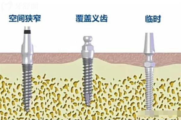 奥齿泰种植体型号和规格表大全:四大系列满足不同患者种植需求