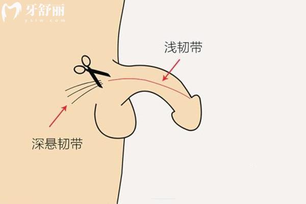 重庆李世荣做阴茎延长增粗术多少钱？