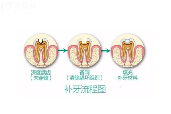 牙齿缺损到哪种程度需要补牙