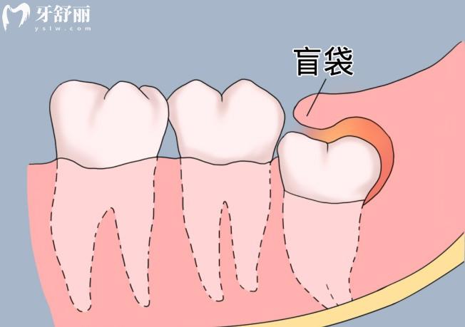 智齿长盲袋是什么样的?智齿有盲袋位置正要拔吗?下文带你来揭秘
