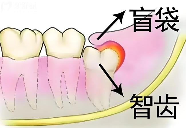智齿长盲袋是什么样的?智齿有盲袋位置正要拔吗?下文带你来揭秘