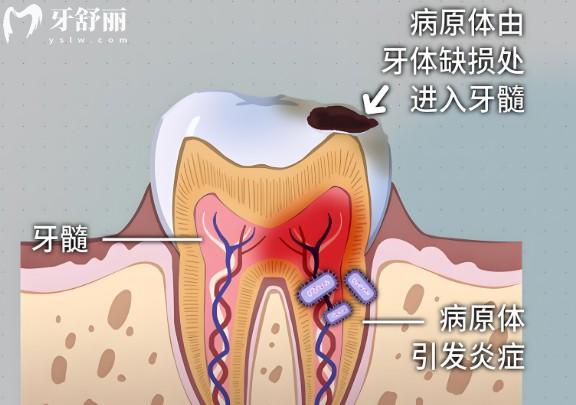 慢性牙髓炎的病因