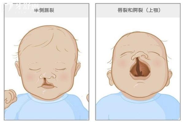 余文林做唇裂修复评价不错:一文分享余文林医生唇裂修复技术/口碑/费用