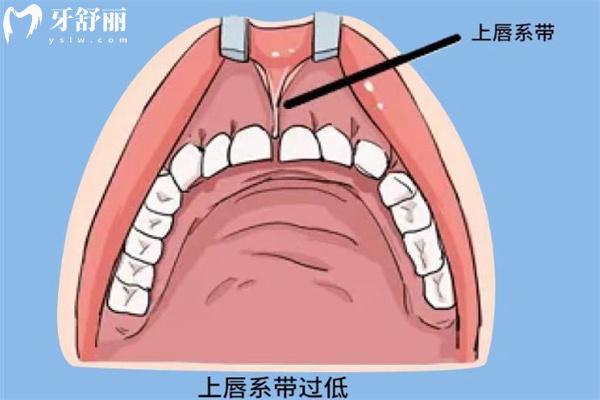 余文林做唇裂修复评价不错:一文分享余文林医生唇裂修复技术/口碑/费用
