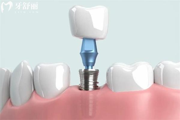 镶什么牙实惠耐用?盘点常见义齿修复方法有哪几种类型及优势如何