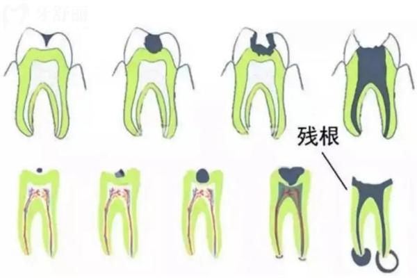 残牙根拔了好还是不拔好?看看良心牙医的拔牙忠告吧!