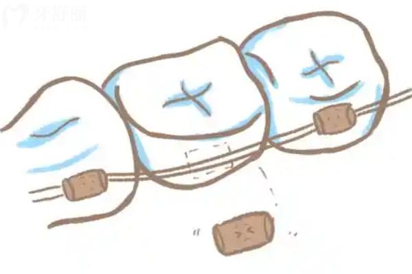 北仑哪家牙科医院矫正牙齿好