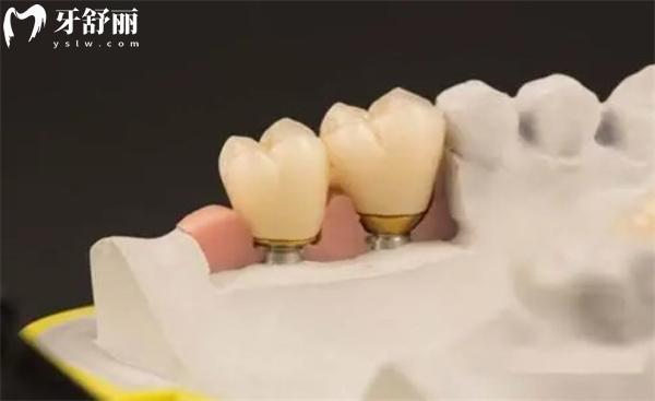 吸附性义齿真的那么好吗?和种植牙对比哪个好?分析优缺点及价格表