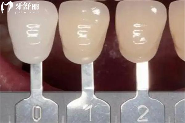 牙冠戴久了里面真牙会坏吗?盘点牙冠一般寿命是多久及牙冠更换周期建议