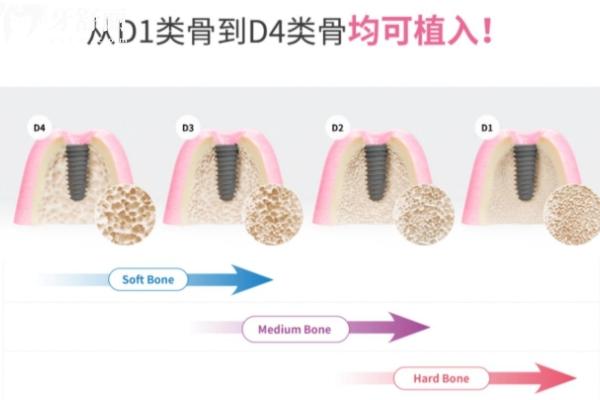 Dio种植体不是杂牌
