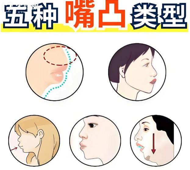 儿童骨性嘴凸几岁能矫正?快来看儿童嘴凸矫正的较佳年龄及价格表