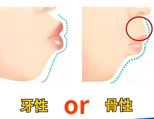 儿童骨性嘴凸几岁能矫正?快来看儿童嘴凸矫正的较佳年龄及价格表