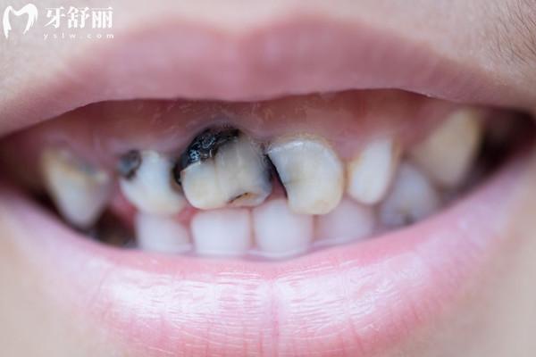 怎么让孩子的牙齿质量好些