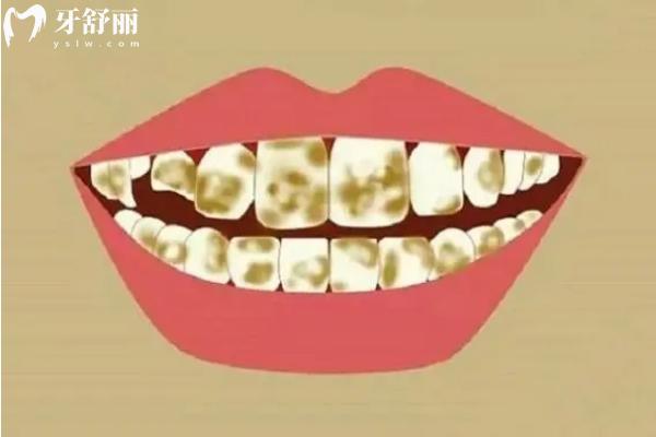 12岁孩子牙齿黄要注意！外源性和内源性两种情况要分清
