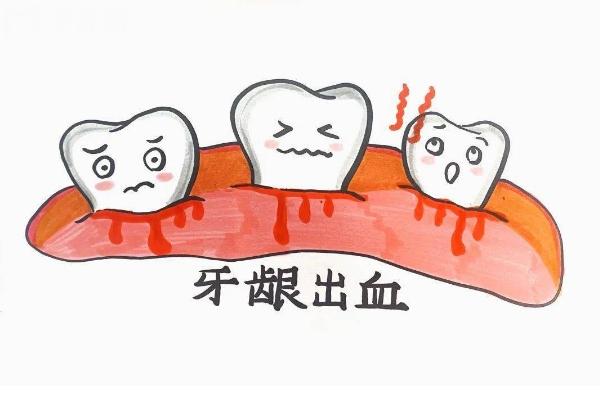 牙龈经常出血是咋回事？口腔卫生没做好/牙周病等原因点击查看预防