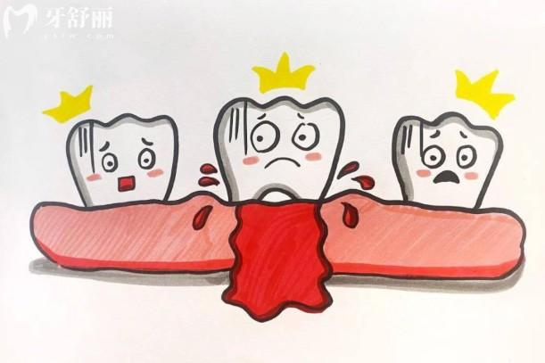 2025牙周炎治疗新收费标准：从洗牙到手术，不同位置收费全解析！