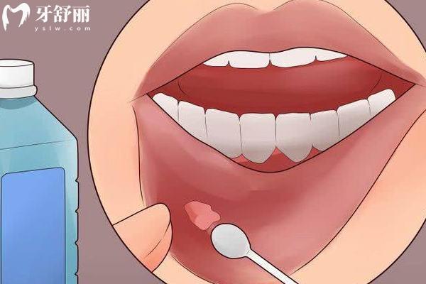 口腔溃疡反复来袭？教你快速治疗和预防的方法！