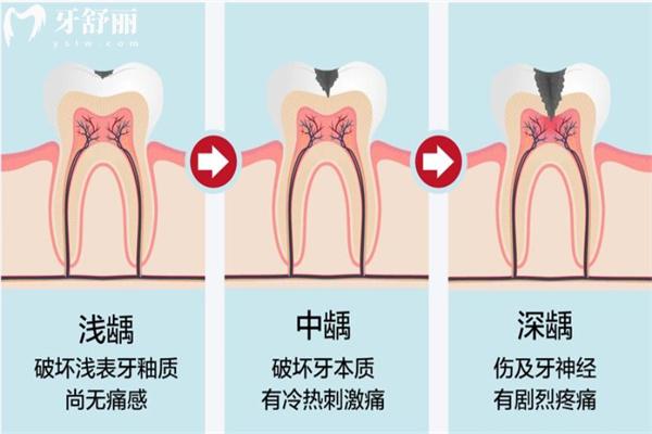 为什么龋齿都在大牙上长?了解龋齿的好发部位才能做好龋齿的预防和护理