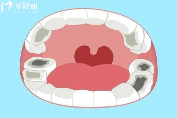 为什么龋齿都在大牙上长?了解龋齿的好发部位才能做好龋齿的预防和护理