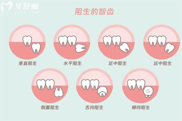 智齿拔了后悔死了!盘点智齿哪些用拔掉哪些不用拔的原因便知道