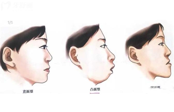 正颌手术费用