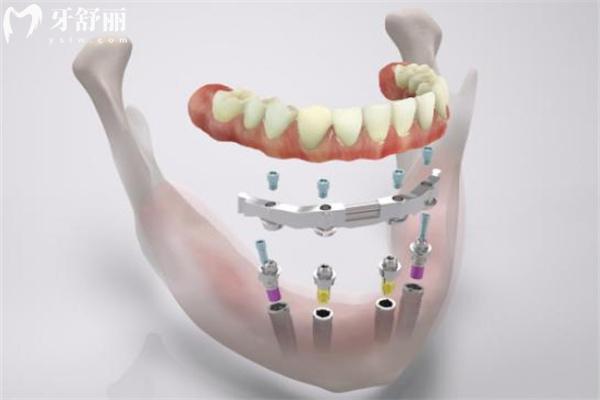 满口假牙哪种比较舒服?盘点常见满口假牙的种类及价格vs舒适度选择
