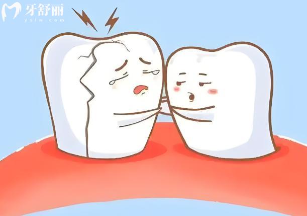 了解牙釉质裂纹和牙隐裂的区别及对应的治疗方案,看牙不迷路