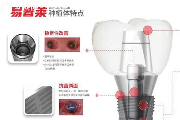 种牙有哪些品牌的性价比高?2025不可错过的口碑种植牙品牌排行榜来喽!