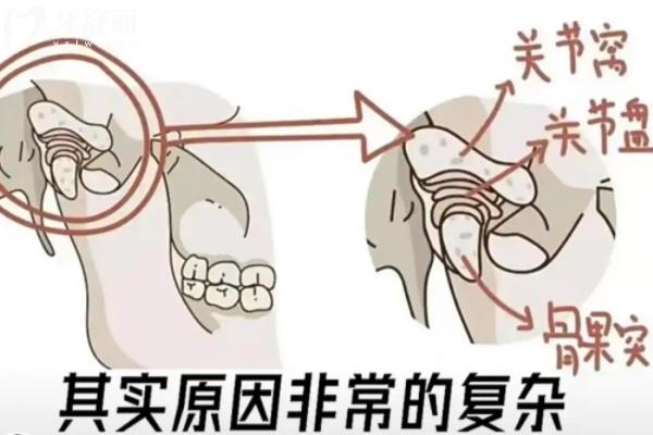 颞颌关节紊乱是什么原因造成的
