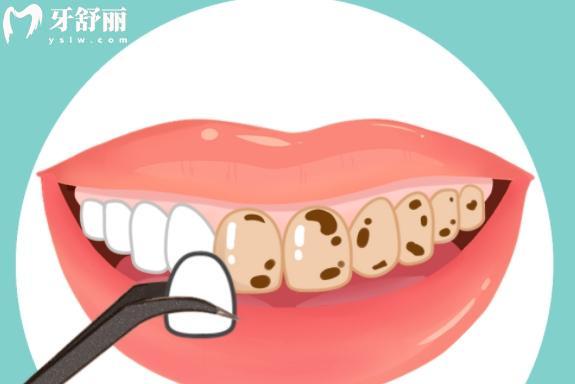 牙齿怎么才可以变白