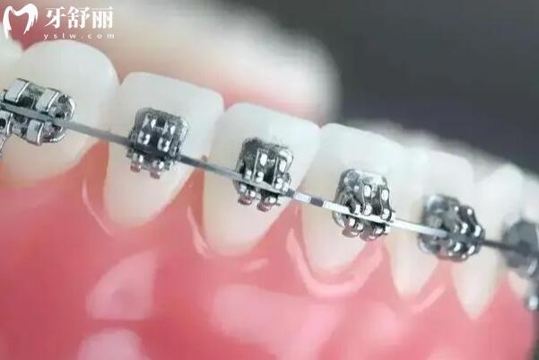 西宁中诺口腔收费怎么样高吗?2025价格表:种植牙2668元起、全瓷牙冠999元起不贵 西宁中诺口腔收费怎么样高吗?2025价格表:种植牙2668元起、全瓷牙冠999元起不贵