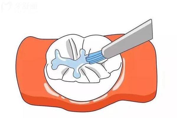 窝沟封闭材料脱落怎么办？及时补，防止龋坏加深