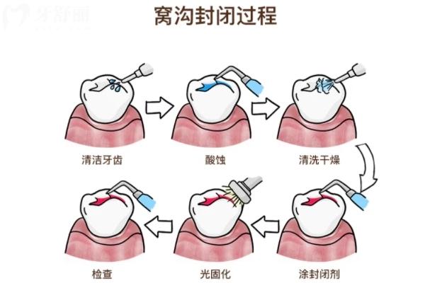 窝沟封闭材料脱落怎么办？及时补，防止龋坏加深