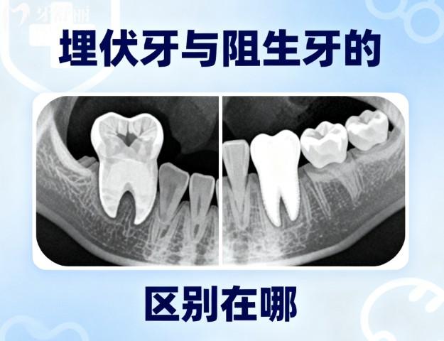 埋伏牙与阻生牙的区别在哪?还有相对应的治疗方案及术后注意事项分享
