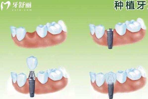 为什么牙医都推荐种植牙？不仅仅是好看，更是为了保住你的牙槽骨