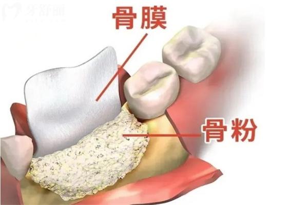 一颗种植牙价位多少钱合理?盘点常用种植牙品牌及价格表2k-1w是合理收费