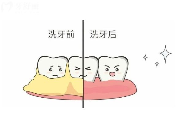 牙齿抛光的作用与注意事项，分享清洁护齿 + 美观优化的口腔手段