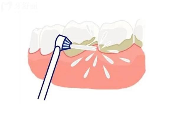 糖尿病人群的口腔护理，需要一份特别指南