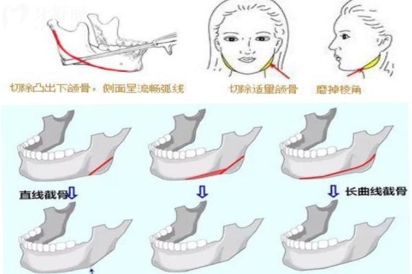 广大医院正颌及磨骨手术费用价格表更新:有国内出名的磨骨/正颌医生徐威强和艾伟健