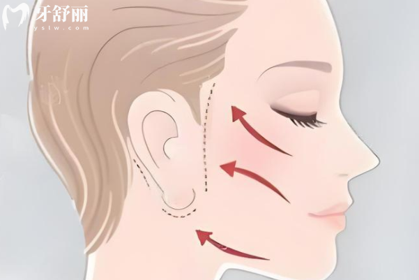 微拉美vs无痕筋膜悬吊提升术