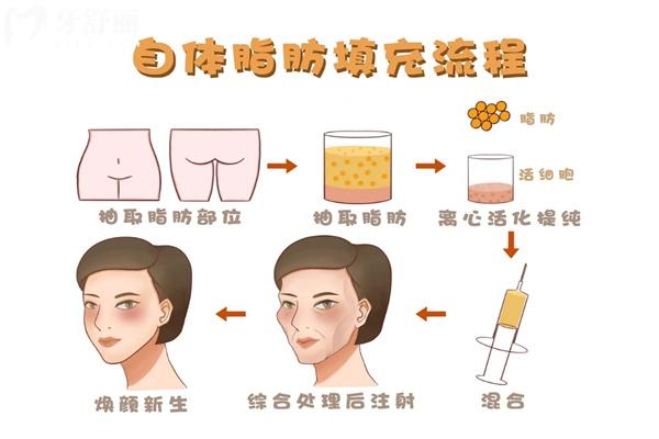 大小脸矫正需要多少钱
