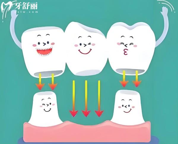 后三颗大牙没了怎么镶？种植牙、活动义齿、烤瓷桥修复牙齿缺失挺不错