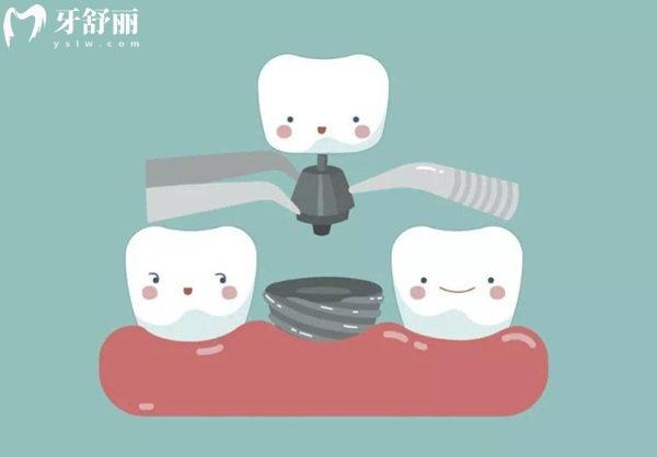 进口种植牙品牌推荐:韩国登腾/瑞士ITI/瑞典诺贝尔/美国皓圣等有质保价格不贵