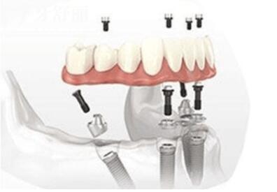 广州暨南雅皓口腔收费贵吗2026收费标准:韩系种植牙1668(全包)、金属矫正7188元起、全瓷冠1280元起