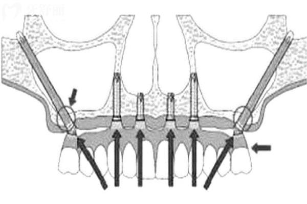 种牙越多越便宜吗?带你详细了解种植牙价格高低区别在哪里? 种牙越多越便宜吗?带你详细了解种植牙价格高低区别在哪里?